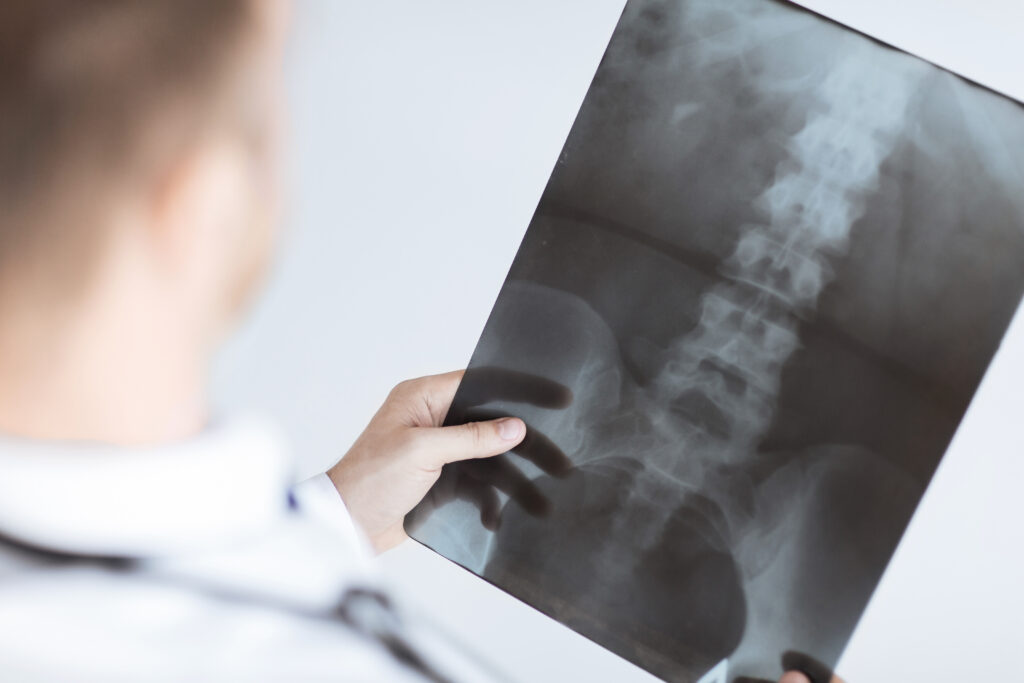 x-ray showing spinal injuries and the need for a spinal injury attorney.